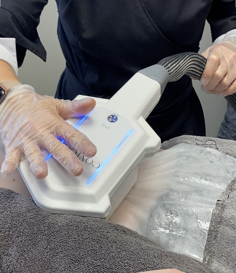 Cryolypolise et laser diode focalisé